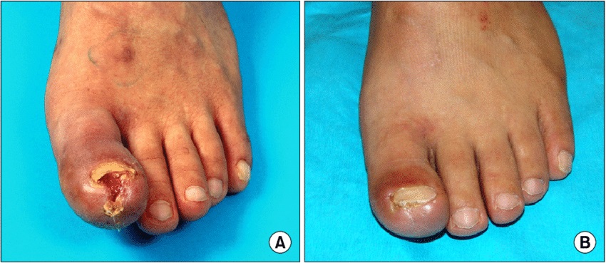 BEFORA AND AFTER TREATMENT